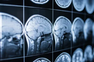 BRAIN & SPINAL CORD INJURY ATTORNEYS