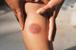 Treatment of Burn Injuries in Washington, DC