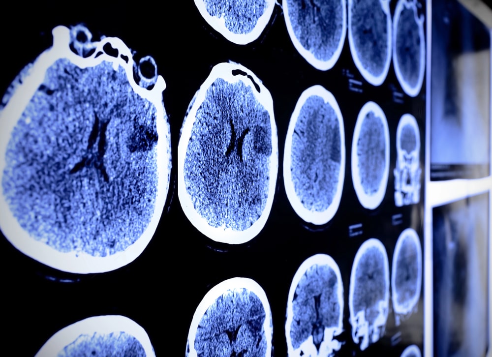 TBI lawyer Richmond, VA